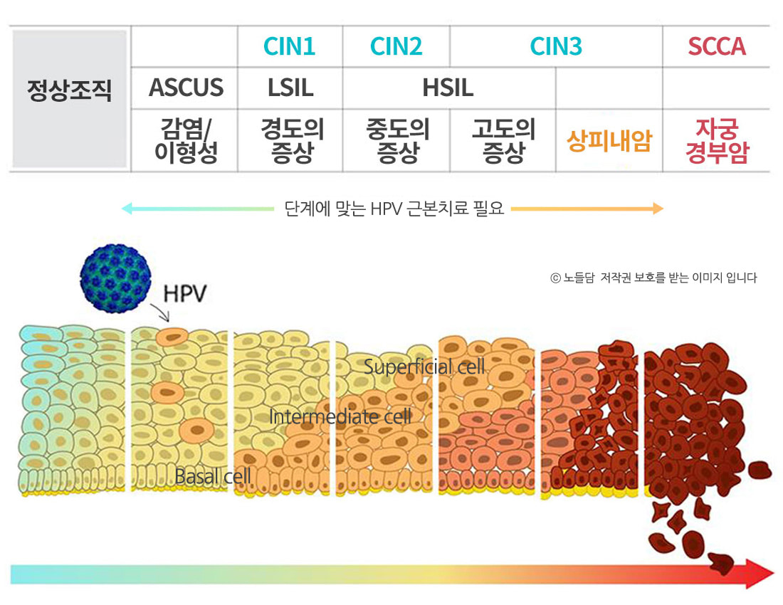자궁경부이형성증 단계 표|CIN1 CIN2 CIN3 구별|1단계 2단계 3단계 차이점 그림