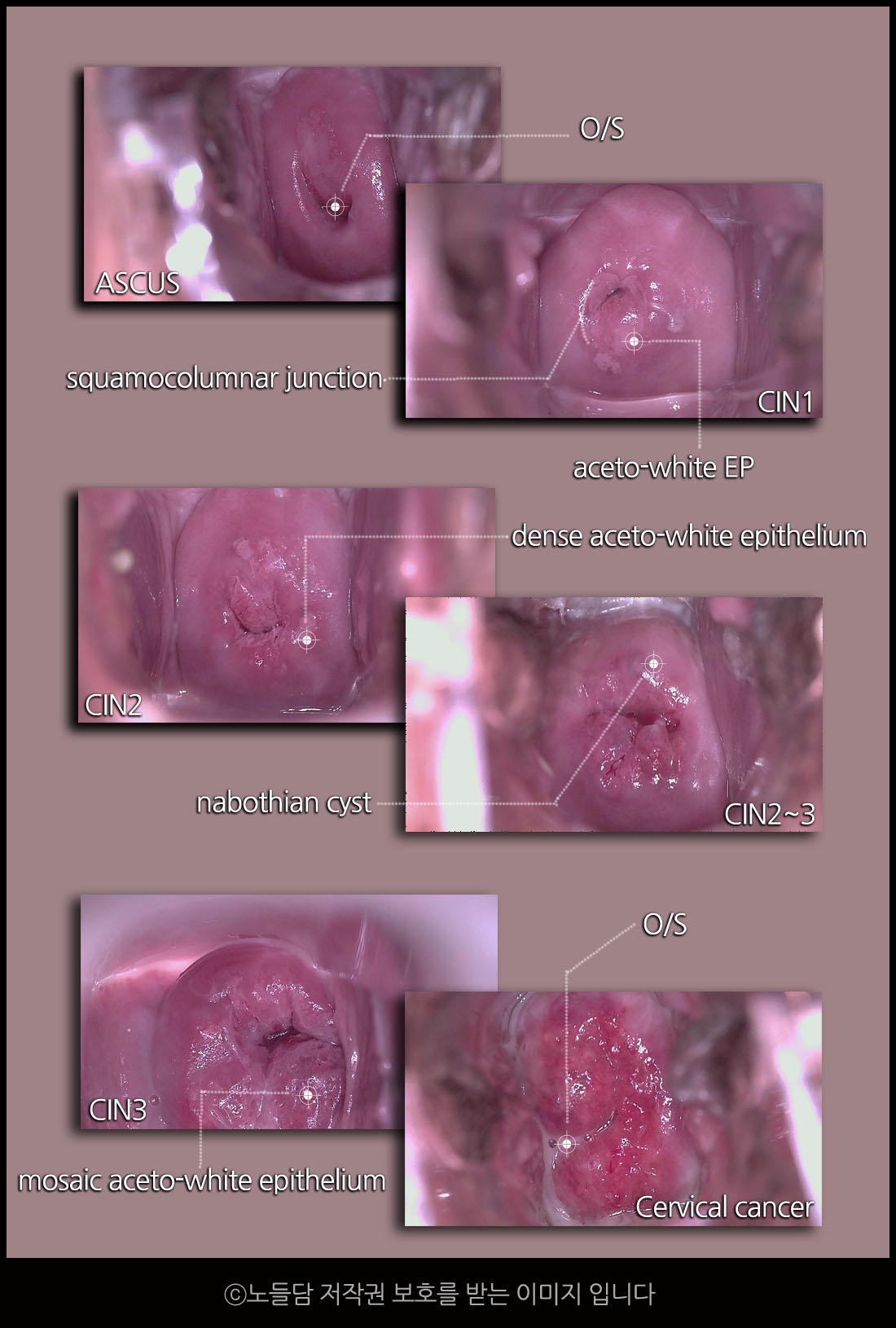 자궁경부이형성증 사진|단계별 증상 사진|colposcopy