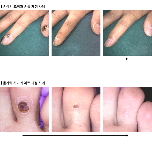 손상된 조직과 손톱 재생 사례, 발가락 사마귀 치료 과정 사례